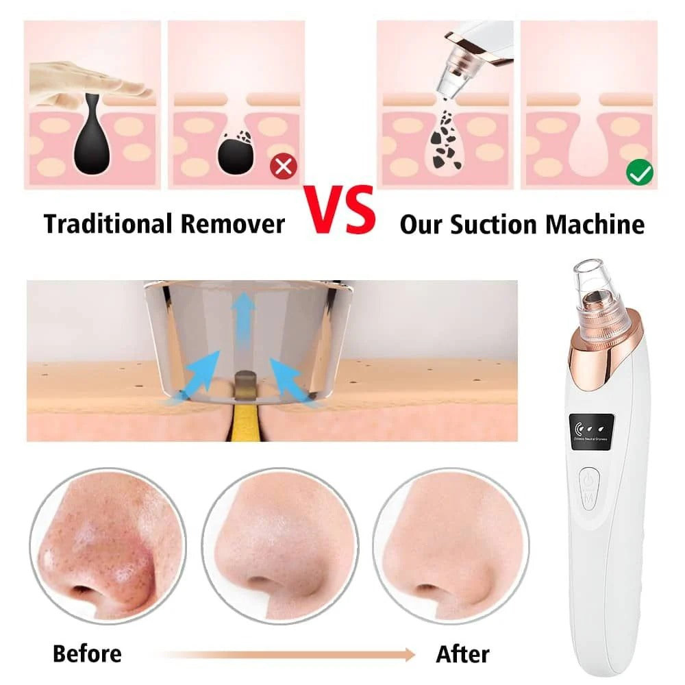 Electric Blackhead Remover & Pore Vacuum – 5-in-1 Acne & Deep Cleaning Tool